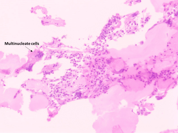 Adding Evidence To Plasmacytoma: A Case Series - Pmc