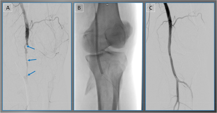 Viabahn stent graft for arterial injury management: safety, technical ...