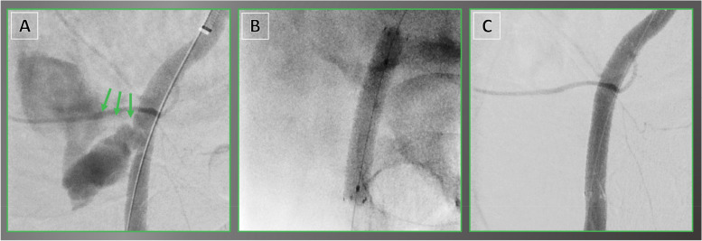 Viabahn stent graft for arterial injury management: safety, technical ...