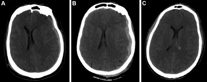 Example predictions by fusion model on University of Pittsburgh Medical Center patients. (A) Correct prediction in a 44-year-old man who was involved in an unrestrained motor vehicle collision. He underwent emergent decompressive hemicraniectomy (DHC), had bilateral lung injuries, and ultimately developed a pulmonary embolism with difficulty oxygenating on posttrauma day 6. His care was withdrawn, and he died. The model correctly predicted mortality. (B) Incorrect prediction in a 57-year-old woman who was in a motor vehicle collision and underwent DHC. The model predicted she would die, but she had a Glasgow Outcomes Scale of 3 at 2 years after trauma. She lived in a nursing home and was dependent on others for most daily living activities. (C) Incorrect prediction in a 28-year-old man who was in a motorcycle collision and had a minor head injury with intraventricular hemorrhage. Several weeks after trauma, he developed Klebsiella ventriculitis and pneumonia that led to an episode of severe hypotension. He subsequently developed malignant cerebral edema and died by brain death criteria. While the model predicted this patient would survive, this scenario highlights the difficulty of predicting outcomes based on information available in the emergency department, as events later in the patient’s course affect outcomes.