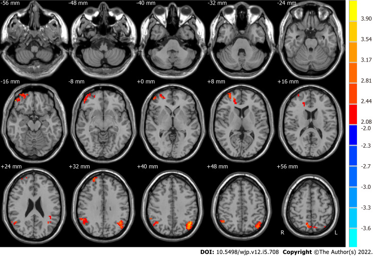 gabapentin before ect