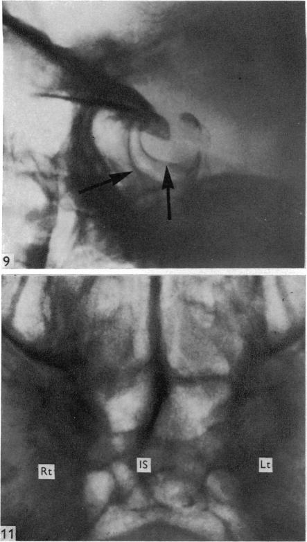 Figs. 9,11