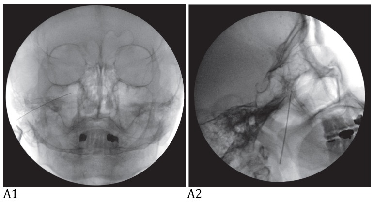 Trigeminal nerve block with alcohol for medically intractable classic ...