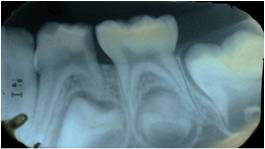 Figure 2: IOPA of 84 showing radiolucency in distal side
involving enamel, dentin and approximating the distal pulp horn.