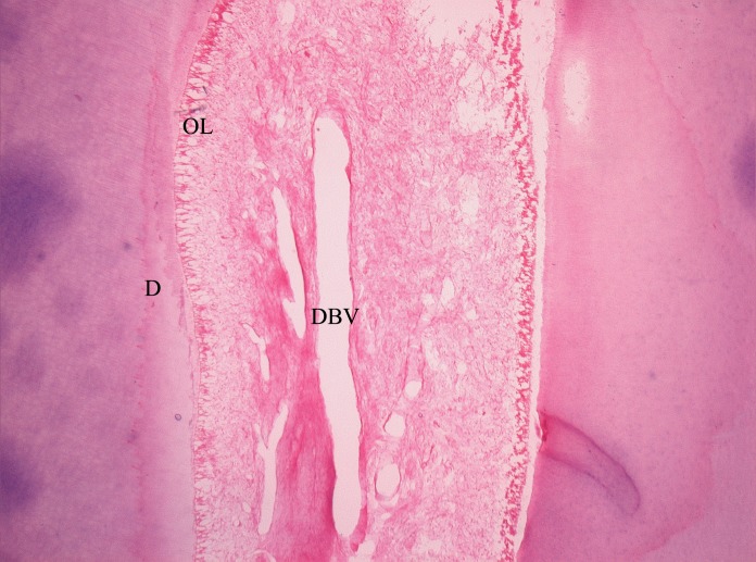 Figure 11: Pulp tissue reaction with 1:5 diluted
formocresol (Group B) [HandE, 4X] shows fibrocellular stroma with
dilated blood vessels.