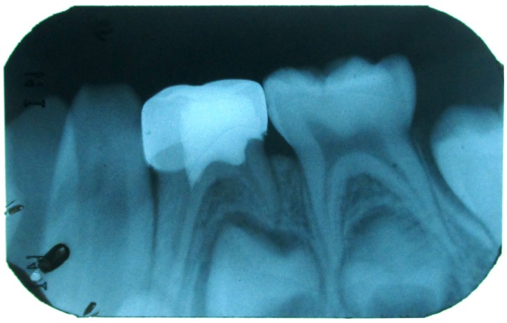 Figure 5: IOPA with 84 after 1 month.