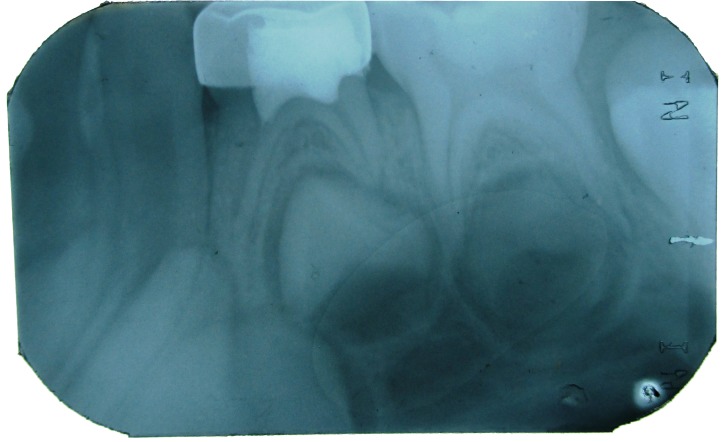 Figure 4: IOPA showing the stainless steel crown restoration
and pulpotomy with 84.