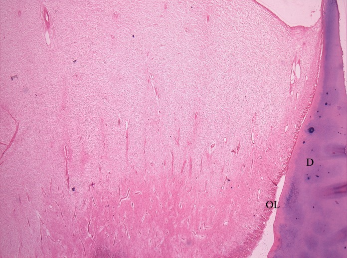 Figure 12: Pulp tissue reaction to 1:25 diluted formocresol
(Group C) [HandE, 4X] shows increased number of fibroblasts
(hypercellular stroma) in the stromal tissue.