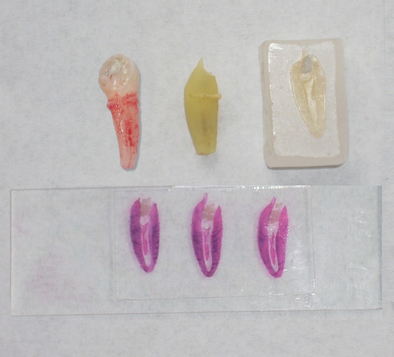 Figure 9: Extracted pulpotomized premolar, decalcified,
mounted on paraffin block, sectioned and stained.