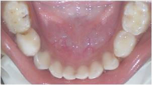 Figure 1: Intraoral findings in the case selected for
pulpotomy showing caries with 84.