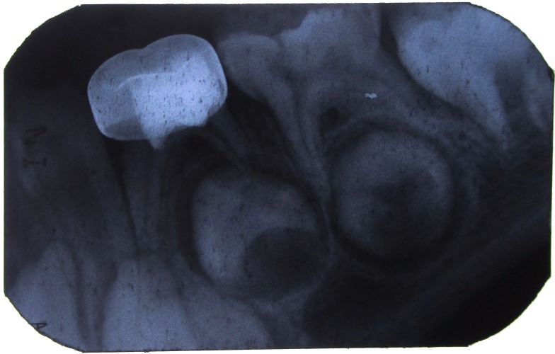 Figure 7: IOPA with 84 after 6 months.