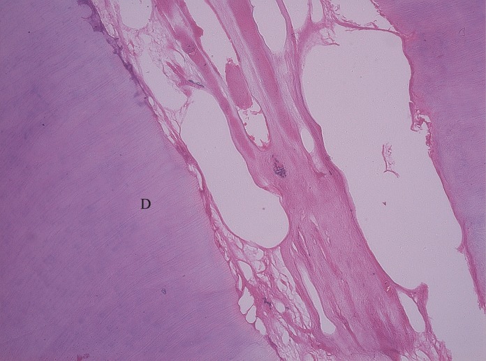 Figure 10: Pulp tissue treated with full strength
formocresol (HandE, 10 X) shows severe fibrosis (hyalinization)
of collagen fibers.