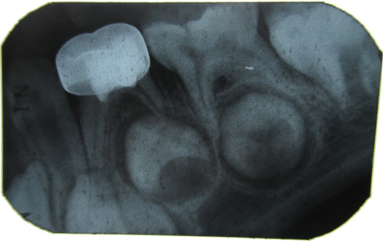 Figure 6: IOPA with 84 after 3 months.