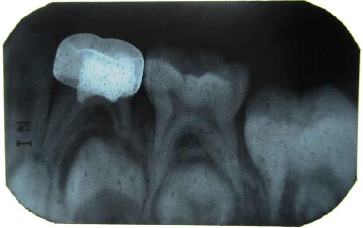 Figure 8: IOPA with 84 after 9 months.