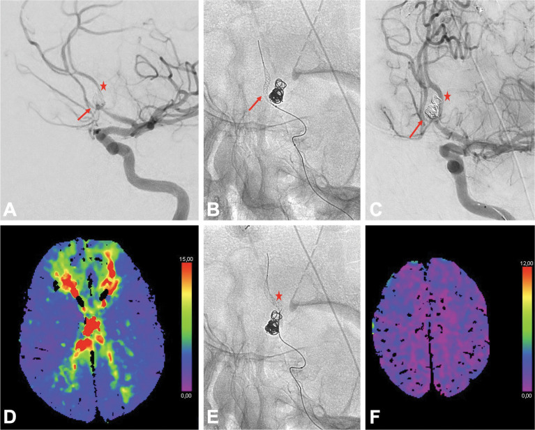 use of the Comaneci for anterior cerebral artery vasospasm