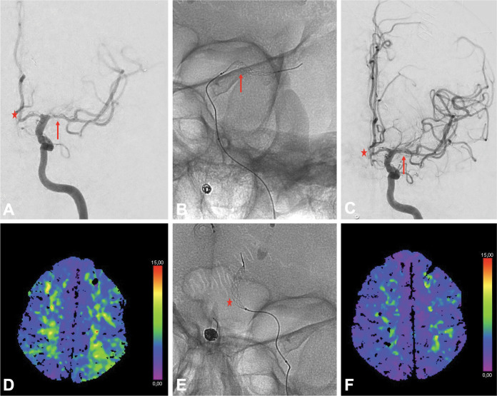 use of Comaneci for anterior and middle cerebral artery vasospam