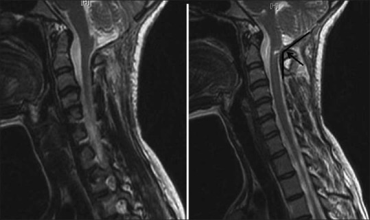 Importance of C1 laminectomy in foramen magnum decompression surgery: A ...