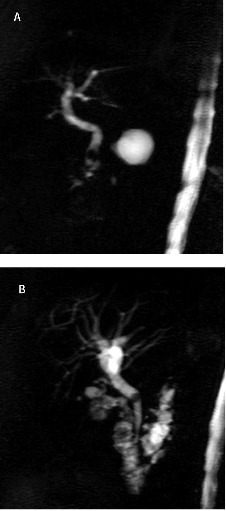 ct-vs-mrcp-in-choledocholithiasis-jaundice-pmc