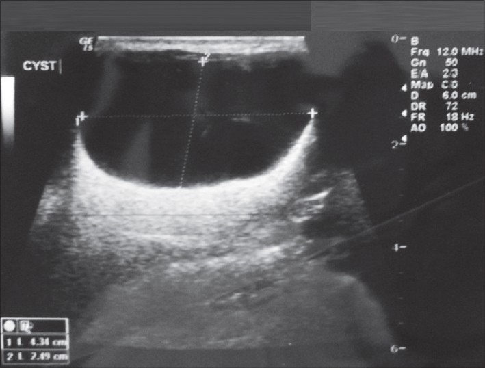 Adenolymphoma: A probing entity: Case report and review - PMC