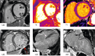 Vidula et al retrospectively analyzed 1047 patients, from 18
international sites, with confirmed COVID-19 infection who underwent cardiac
MRI. (A) Example cardiac MR images in a patient with acute myocarditis
linked to a recent COVID-19 infection show subepicardial late gadolinium
enhancement (LGE) in the midinferior and inferoseptal walls (left image,
indicated by white arrow). There are also elevated native T2 times (middle
image, white arrow) and native T1 times (right image, white arrow) in the
midinferior wall. (B) Example cardiac MR images in a patient after a
complicated COVID-19 hospitalization reveal nonacute, nonischemic injury.
There is extensive midmyocardial LGE in the septum (left image, white arrow)
and subepicardial LGE in the inferior and inferolateral walls visible on the
short-axis view (left image, red arrow). The midmyocardial LGE in the septum
is also seen on the four-chamber view (middle image, white arrow), and
subepicardial LGE in the inferior wall appears on the two-chamber view
(right image, white arrow). (Reprinted, with permission, from reference
29.)
