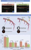 The Precise Percutaneous Coronary Intervention Plan (P3) trial
evaluated the relationship between atherosclerotic plaque phenotypes and
focal and diffuse coronary artery disease (CAD) defined by coronary
hemodynamics. The study included patients with hemodynamically significant
CAD based on fractional flow reserve (FFR), with plaque characterization
based on CT and optical coherence tomography (OCT). Using an OCT pullback
pressure gradient (PPG) index, patients were divided into focal (PPG
> 0.66) or diffuse (PPG ≤ 0.66) CAD (upper panel). Plaque
phenotypes were subsequently analyzed at CT and OCT (middle panel). The
graph shows vessels with focal CAD (red bars) had a higher plaque burden and
predominantly lipid-rich plaque with a high prevalence of high-risk thin-cap
fibroatheroma, whereas calcifications were the hallmark of vessels with
diffuse disease (green bars). The study highlights the different plaque
subtypes in focal versus diffuse disease, which may influence therapeutic
pathways. (Adapted, with permission under a CC BY-NC-ND 4.0 license, from
reference 10.)