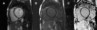 Some nonischemic dilated cardiomyopathies (DCMs) have late gadolinium
enhancement (LGE) localized only at the right ventricular (RV) insertion
points (IP-LGE). Claver et al sought to evaluate the prognostic implications
of IP-LGE, as well as LGE present at both the RV insertion points and left
ventricle, in 1165 patients with DCM. Representative cardiac MR images in a
patient with IP-LGE: (A) cine left ventricular short-axis view, (B) LGE
magnitude, and (C) phase-sensitive inversion recovery, all synchronized at
the same phase of the cardiac cycle. The LGE sequences show a prominent area
of inferior IP-LGE. The study found that insertion point LGE did not affect
outcomes among patients with DCM. (Adapted, with permission, from reference
25.)