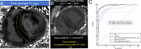 Kidoh et al explored the diagnostic performances of the traditional
MRI ECV method and the newer method of myocardium to lumen R1 ratio on
postcontrast T1 maps, which has the advantage of not requiring a native T1
map and hematocrit levels. (A) Example of region of interest placement on
postcontrast T1 maps in a patient with cardiac amyloidosis. The ratio of
myocardial R1 to luminal R1 on the postcontrast T1 map was defined as
postcontrast myocardium to lumen R1 ratio. (B) Postcontrast T1 map in a
70-year-old male individual with suspected cardiac amyloidosis. The mean R1
values of the septal wall were higher than those of the lumen (postcontrast
myocardium to lumen R1 ratio = 1.36). The ECV value was 78% (abnormally
high). Wild-type transthyretin amyloidosis (ATTRwt) was confirmed using
genetic testing. (C) Receiver operating characteristic curves for the
detection of patients with cardiac amyloidosis. The highest area under the
receiver operating characteristic curve (AUC) was attained with ECV (0.99
[95% CI: 0.97, 1.00], P < .001), followed by Λ (0.98 [95% CI:
0.96, 0.99], P < .001), and then, postcontrast myocardium-to-lumen R1
ratio (0.98 [95% CI: 0.95, 0.99], P < .001). There was no evidence of
a difference in AUC between ECV and postcontrast myocardium to lumen R1
ratio (P = .10) or between Λ and postcontrast myocardium to lumen R1
ratio (P = .19). ECV = extracellular volume fraction. (Adapted, with
permission, from reference 21.)