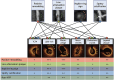 Kinoshita et al evaluated patients who underwent both CT and optical
coherence tomography (OCT) to analyze high-risk plaque features at CT
(positive remodeling, low-attenuation plaque, napkin ring sign, and spotty
calcification) that correlated with vulnerable OCT plague features.
Statistically significant associations between multiple high-risk plaque
(HRP) features and each OCT feature of vulnerability are depicted by
highlighted dots and lines connecting features. Positive remodeling was the
most foundational HRP feature and associated with all six OCT features of
plaque vulnerability. The others have more specific associations with
individual OCT features of vulnerability. The prevalence of each OCT feature
is represented as follows: +++ indicates ≥75%, ++ indicates
50%–74%, + indicates 25%–49%, and – indicates
<25%. The prevalence pattern was similar among the four HRP CT
features. In the representative images of each HRP feature, positive
remodeling is indicated by green arrowheads, low-attenuation plaque by
yellow dotted outlines, napkin ring sign by orange arrowheads, and spotty
calcification by a white arrow. Yellow arrowheads indicate the labeled
representative OCT feature of vulnerability. TCFA = thin-cap fibroatheroma.
(Adapted, with permission, from reference 15.)