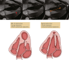 Sherrid et al evaluated the imaging and physiologic features of mid
left ventricle (LV) obstruction and its frequency in hypertrophic
obstructive cardiomyopathy apical aneurysms. The upper panel shows a
hypertrophied LV from end diastole to end systole, obstructing the papillary
muscle (PM) (red arrow). Relatively apical insertion of the PM causes
obstruction at the apical-to-mid level, with a resulting small aneurysm
(white arrow). The subvalvular apparatus (SVA) is long (orange double
arrow). The schematic on the left side of the lower panel shows mid-LV
obstruction, short SVA (double arrow), and large apical aneurysm with
hypertrophic involvement of the PM. The right-hand schematic shows
apical-mid obstruction, long SVA (double arrow), and a small apical
aneurysm. (Reprinted, with permission, from reference 27.)