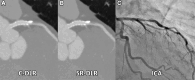 Images in a 66-year-old male individual after percutaneous coronary
intervention of the left anterior descending artery. (A, B) On coronary CT
angiogram, edge of stent and calcified and noncalcified plaque all appear
sharper using (B) super-resolution deep learning reconstruction (SR-DLR)
than using (A) conventional deep learning reconstruction (C-DLR). (C)
Invasive coronary angiogram (ICA) demonstrates mild stenosis in the left
anterior descending artery. The study highlights the improving capabilities
of SR-DLRs to improve coronary image reading. (Reprinted, with permission,
from reference 2.)