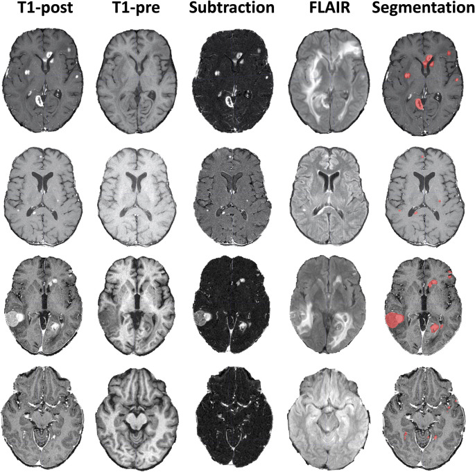 Example brain metastases data. Four example MRI studies with axial T1 postcontrast images (T1-post), T1 precontrast images (T1-pre), subtraction images, postcontrast fluid-attenuated inversion recovery (FLAIR) images, and ground truth segmentations overlaid on the T1-post images.