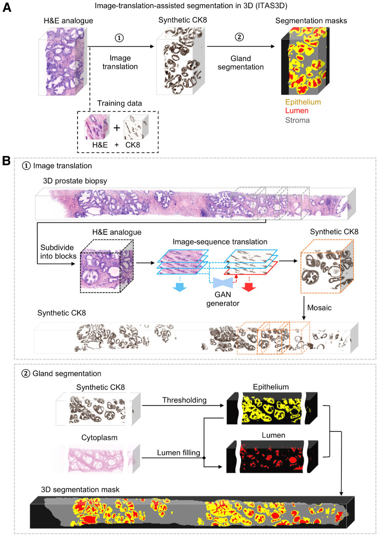 Figure 2. ITAS3D: a two-step pipeline for annotation-free 3D segmentation of prostate glands. A, In step 1, a 3D microscopy dataset of a specimen, stained with a rapid and inexpensive fluorescent analogue of H&E, is converted into a synthetic CK8 immunofluorescence dataset by using an image-sequence translation model that is trained with paired H&E analogue and real-CK8 immunofluorescence datasets (tri-labeled tissues). The CK8 biomarker, which is utilized in standard-of-care genitourinary pathology practice, is ubiquitously expressed by the luminal epithelial cells of all prostate glands. In step 2, traditional computer-vision algorithms are applied to the synthetic-CK8 datasets for semantic segmentation of the gland epithelium, lumen, and surrounding stromal regions. B, In step 1, a 3D prostate biopsy is subdivided into overlapping blocks that are each regarded as depth-wise sequences of 2D images. A GAN-trained generator performs image translation sequentially on each 2D level of an image block. The image translation at each level is based on the H&E analogue input at that level while leveraging the H&E analogue and CK8 images from two previous levels to enforce spatial continuity between levels (i.e., a “2.5D” translation method). The synthetic-CK8 image-block outputs are then mosaicked to generate a 3D CK8 dataset of the whole biopsy to assist with gland segmentation. In step 2, the epithelial cell layer (epithelium) is segmented from the synthetic-CK8 dataset with a thresholding-based algorithm. Gland lumen spaces are segmented by filling in the regions enclosed by the epithelia with refinements based on the cytoplasm channel (eosin fluorescence). See Supplementary Methods for details.