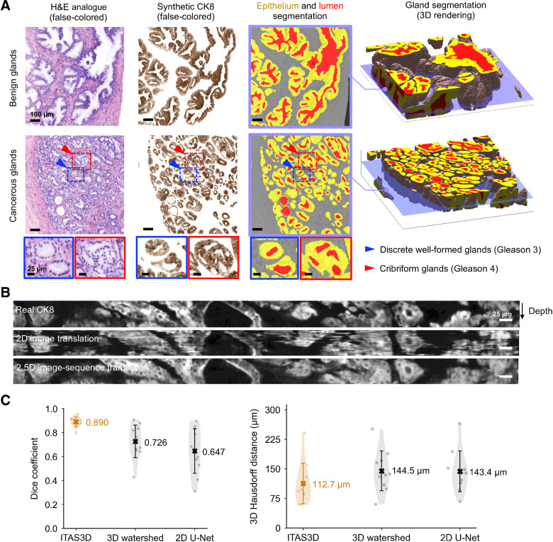 Figure 3. Segmentation results with ITAS3D. A, 2D cross-sections are shown (from left to right) of false-colored H&E analogue images, synthetic-CK8 IHC images generated by image-sequence translation, and gland-segmentation masks based on the synthetic-CK8 images (yellow, epithelium; red, lumen; gray, stroma). The example images are from large 3D datasets containing benign glands (first row) and cancerous glands (second row). Zoom-in views show small discrete well-formed glands (Gleason pattern 3, blue box) and cribriform glands (Gleason pattern 4, red box) in the cancerous region. Three-dimensional renderings of gland segmentations for a benign and cancerous region are shown on the far right. Scale bar, 100 μm. B, Side views of the image sequences (with the depth direction oriented down) of real- and synthetic-CK8 immunofluorescence images. The 2.5D image translation results exhibit substantially improved depth-wise continuity compared with the 2D image translation results. Scale bar, 25 μm. C, For quantitative benchmarking, Dice coefficients (larger is better) and 3D Hausdorff distances (smaller is better) are plotted for ITAS3D-based gland segmentations along with two benchmark methods (3D watershed and 2D U-net), as calculated from 10 randomly selected test regions. Violin plots are shown with mean values denoted by a center cross and SDs denoted by error bars. For the 3D Hausdorff distance, the vertical axis denotes physical distance (in microns) within the tissue.