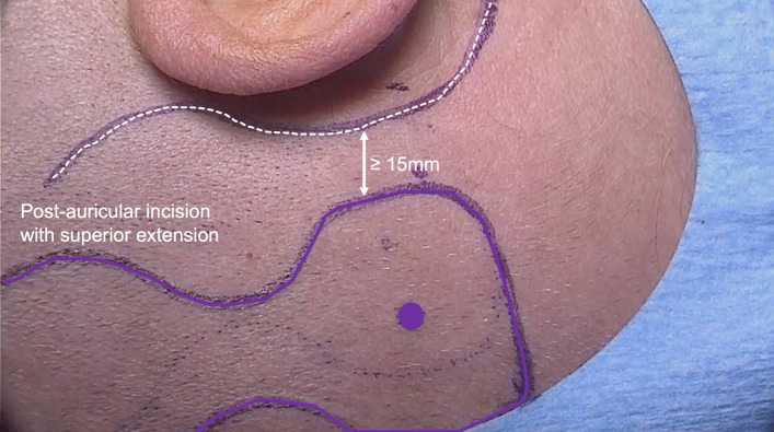 How I do it: Cochlear Osia 2 System surgery placement - PMC