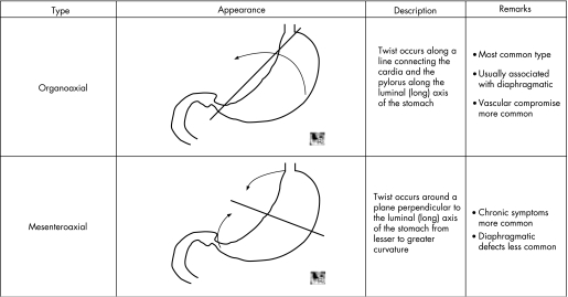 Gastric volvulus - PMC