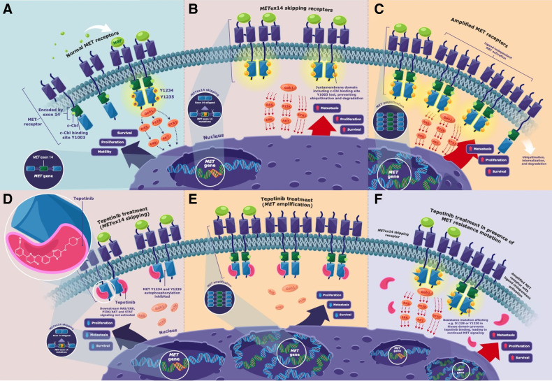 Figure 1. Simplified diagrammatic schema showing A, In a physiologically normal context, MET signaling is activated when the HGF ligand binds to the extracellular domain of the MET receptor that induces homodimerization and stimulates auto-phosphorylation of the tyrosine residues Y1234 and Y1235 in the cytoplasmic regions of the receptor. This leads to activation and recruitment of the adaptor/scaffold protein Gab1 and activation of downstream signaling pathways (including RAS/ERK, PI3K/AKT, and STAT), resulting in cell survival, proliferation, and motility. Under normal physiological conditions there is a balance between MET signaling and downregulation of MET (3, 4). In addition to MET signaling from the interaction between the ligand and the MET receptor, there have been published reports of MET internalization promoting additional signaling whereby the formation of early MET-containing endosomes can (i) trigger the activation of ERK leading to focal adhesions of the phosphorylated ERK that may mediate HGF-induced cell migration, or (ii) MET may be trafficked along the microtubule network and accumulate in a perinuclear compartment where it may trigger the phosphorylation of STAT3 leading to the translocation of the phosphorylated STAT3 into the nucleus, which could induce downstream signaling (3–5). Publications have also reported the downregulation of MET may occur through (i) endocytosis of MET and the formation of multivesicular bodies leading to MET undergoing lysosomal degradation, or (ii) MET degradation may occur through sequential proteolytic cleavage at the juxtamembrane site, with the cleaved intracellular MET fragment being destroyed in the proteasome, whereas the cleaved extracellular MET may generate an extracellular “decoy MET” that could capture the HGF ligand and interfere with other intact MET receptors (3, 4). B, Dysregulation of the MET pathway can occur through several mechanisms including alterations in the MET gene, such as METex14 skipping (METex14 encodes the MET receptor juxtamembrane domain, which contains negative regulatory elements such as the Y1003-binding site for c-Cbl E3 ubiquitin ligase, which under normal conditions would facilitate the ubiquitination of the MET receptor, resulting in the internalization, trafficking to late endosomes and degradation. However, in tumors harboring METex14 skipping, the receptor is truncated and the loss of this binding site for c-Cbl E3 ubiquitin ligase results in reduced ubiquitination and degradation of the receptor, through decreased lysosomal receptor degradation, leading to sustained MET signaling that can promote uncontrolled proliferation, survival, and metastasis. C, Dysregulation of the MET pathway can also occur through METamp (where the increase in the MET copy number results in increased synthesis of MET, leading to increased MET signaling and subsequent increased cell proliferation, survival, and metastasis). Frazier et al. have reported ligand-independent phosphorylation of receptor tyrosine kinases (RTK) in cancer cells with METamp, where co-localization of MET and RTKs can occur in the Golgi apparatus, and the researchers postulated that when MET is overexpressed, it may accumulate in the Golgi apparatus and this overcrowding facilitates the nonspecific interaction between MET and newly synthesized RTKs (during the RTK trafficking to the plasma membrane) leading to the premature phosphorylation of RTKs and their subsequent downstream effect (5). In tumors harboring METex14 skipping (D) or METamp (E), the MET inhibitor tepotinib binds to the kinase domain and blocks the autophosphorylation of the intracellular domain of the MET receptor, thereby impeding the activation of the downstream signaling pathways (including RAS/ERK, PI3K/AKT, and STAT), and inhibiting tumor cell proliferation, survival, and metastasis. F, Secondary MET kinase domain mutations affecting for example Y1230 and D1228 prevent the binding of tepotinib to the MET receptor, leading to continued MET signaling. AKT, protein kinase B; c-Cbl, Casitas B-lineage lymphoma; ERK, extracellular signal-regulated kinase; Gab1, Grb2-associated binder 1; HGF, hepatocyte growth factor; MET, mesenchymal–epithelial transition proto-oncogene; METamp, MET amplification; METex14, MET exon 14; PI3K, phosphoinositide 3-kinase; RAS, rat sarcoma viral oncogene; STAT, signal transducer and activator of transcription.