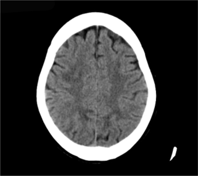 Guillain barr syndrome complicated by posterior reversible
