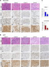 Figure 7. Nuclear immunostaining of PRMT1 and mPFKFB3 is augmented in TNBC cancer cells derived from non-pCR patients. A and B, FFPE IHC of PRMT1, mPFKFB3, and total PFKFB3 in four different patients with TNBC showing non-pCR (A) and in five different patients with TNBC showing pCR (B), respectively. Scale bars, 100 μm. C, Differences in the number of PRMT1- and mPFKFB3-positive nuclei in TNBC cancer cells between non-pCR and pCR patients. *, P < 0.05 versus non-pCR. The differences were examined by Welch t test. H&E, hematoxylin and eosin.