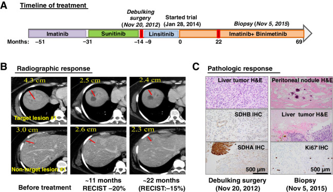 Figure 3. An example of durable treatment response in a patient with an SDH-deficient GIST. A, Treatment timeline and duration of various treatments the patient received for a metastatic SDH-deficient GIST. B, Representative CT images of the patient's metastatic liver lesions before, approximately 11 months and approximately 22 months after receiving the imatinib plus binimetinib combination therapy. One-dimension measurement in centimeters was provided for RECIST1.1 calculation at different time points. C, Treatment response by histopathologic studies. Representative images of histology and IHC stains for SDHB and SDHA, demonstrating dual SDH-deficiency, in the pretreatment tumor samples (debulking surgery; November 20, 2012) and the histology and the proliferation index marker, Ki67 IHC. The histology from the pretrial treatment liver lesions demonstrated more than 95% viable tumor and less than 5% treatment-associated necrosis. The histology from the on-treatment tumor samples (biopsy; November 5, 2015) showed 100% pathologic response with treatment-associated fibrosis, hyalinization, and dystrophic calcification in a resected metastatic peritoneal nodule and 70% pathologic response with treatment-associated necrosis in the metastatic liver lesion and less than 10% Ki67 IHC in the residual viable tumor. H&E, hematoxylin and eosin.