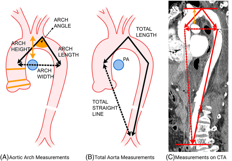 Aortic arch tortuosity, a novel biomarker for thoracic aortic disease ...