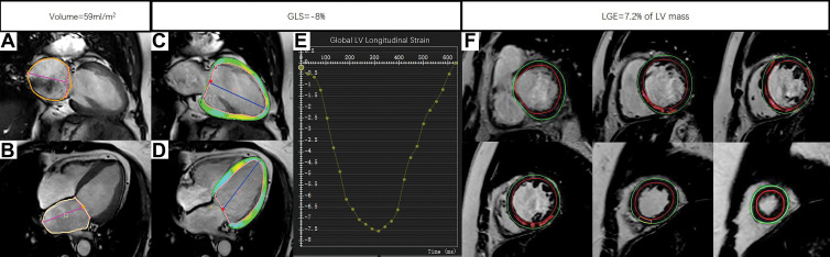 Example MRI studies in a 59-year-old male patient who was hospitalized for heart failure 29 months after the cardiac MRI examination. The maximum left atrial volume index was calculated by the measurements of left atrial area (orange outlines) and left atrial length (magenta lines) in (A) two-chamber view and (B) four-chamber view at end systole with use of the biplane area-length method. The global longitudinal strain (GLS) was obtained by tracing the endocardial (red) and epicardial (green) borders on the (C) two-chamber and (D) four-chamber long-axis images throughout the entire cardiac cycle. The green, yellow, and cyan shading represents left ventricular (LV) longitudinal strain measurements, and the blue lines indicate LV length. (E) The strain curve derived from postprocessing shows GLS to be −8%. The burden of late gadolinium enhancement (LGE) was quantified using the full width half maximum method by drawing the endocardial (red) and epicardial (green) borders on (F) a stack of LV short-axis LGE images. The red shading represents quantified LGE.