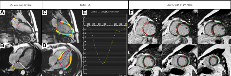 Example MRI studies in a 54-year-old male patient who experienced sudden cardiac death 23 months after the cardiac MRI examination. The maximum left atrial volume index was calculated by the measuring the left atrial area (yellow outlines) and left atrial length (magenta lines) in (A) two-chamber view and (B) four-chamber view at end systole with use of the biplane area-length method. The global longitudinal strain (GLS) was obtained by tracing the endocardial (red) and epicardial (green) borders on the (C) two-chamber and (D) four-chamber long-axis images throughout the entire cardiac cycle, while the green, yellow, and cyan shading represents left ventricular (LV) longitudinal strain measurements. The blue lines indicate LV length. (E) The line plot of strain curve shows GLS to be −9%. The burden of late gadolinium enhancement (LGE) was quantified using the full width half maximum method by drawing the endocardial (red line) and epicardial (green line) borders on (F) a stack of LV short-axis LGE images. The red shading represents quantified LGE.