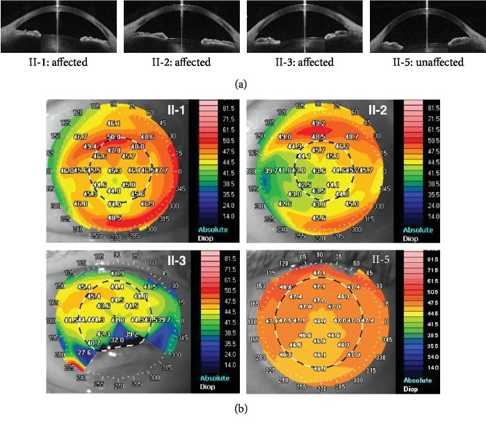 A Cohesin Subunit Variant Identified from a Peripheral Sclerocornea ...