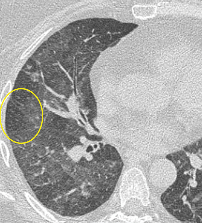 GL-ILD in a 50-year-old woman with common variable immunodeficiency. (a) Axial CT image at initial presentation shows diffuse mosaic attenuation. (b) Axial CT image at follow-up a few months later shows improving mosaic attenuation with new micronodules (yellow oval). Follow-up CT after treatment with systemic steroids (not shown) showed improvement of both the diffuse mosaic attenuation and micronodules.