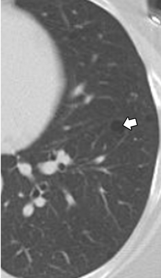 Biopsy-proven extranodal Rosai-Dorfman disease in a 65-year-old woman. (a–c) Axial CT images (lung window) show a patchy consolidation in the right upper lobe (arrow in a) with septal line thickening (arrow in b). Also note the tiny thin-walled cysts in the left lung (arrow in c). (d) Axial CT image (mediastinal windows) shows the axillary and mediastinal adenopathy (green arrows) and a soft-tissue chest wall mass (pink arrow). The most common finding in Rosai-Dorfman disease is lymphadenopathy. Most of these findings resolved with treatment (not shown).