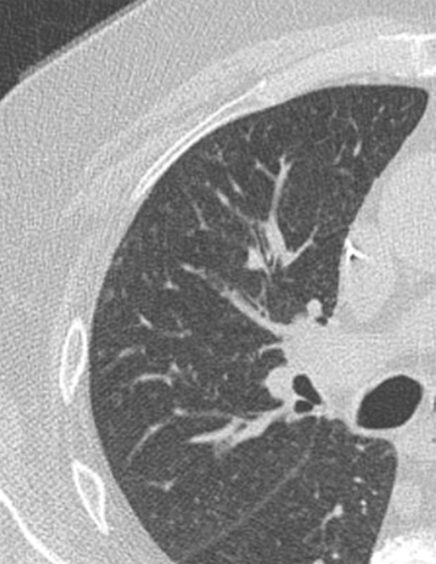 Variable CT imaging appearance of hypersensitivity pneumonitis in three patients. (a) Axial CT image in a 35-year-old man shows multiple centrilobular nodules. (b) Axial CT image in a 56-year-old woman shows mixed ground-glass opacity and mosaic attenuation interspersed with normal lung parenchyma (head cheese sign). (c, d) Axial CT images in a 46-year-old woman with a long history of using a hot tub shows areas of ground-glass attenuation predominantly in the left upper lobe (white oval in c). Evidence of air trapping appears on the expiratory image (d).