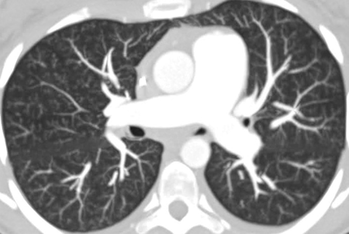 Talcosis in two patients. (a) Axial CT image in a 27-year-old man with inhalational talcosis shows many diffuse centrilobular ground-glass nodules with nodular opacity and internal high attenuation. (b) Axial CT image in a 31-year-old man with intravenous talcosis shows innumerable tree-in-bud nodules with an enlarged main pulmonary artery from resultant pulmonary hypertension. This tree-in-bud distribution is in part due to intravenous particles obstructing terminal pulmonary arteries.