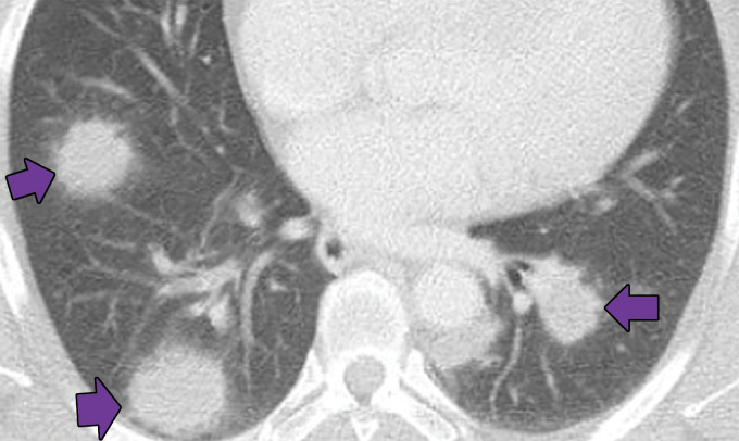 Necrotizing sarcoidosis in a 56-year-old woman. Axial chest CT image shows multiple masslike solid pulmonary nodules with surrounding ground-glass halos (arrows). Percutaneous biopsy of one of the pulmonary nodules showed necrotizing sarcoidosis. These large nodules may cavitate, although cavitation is not present in this case.