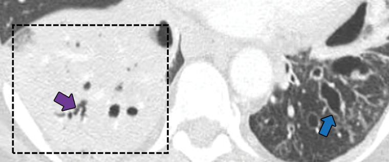 Bronchocentric granulomatosis in three patients. (a) Axial CT image in a 35-year-old man shows a spiculated nodule (arrow) in the left lower lobe. (b) Axial CT image in a 44-year-old woman shows peribronchovascular consolidation (white box) with tiny satellite nodules (arrow). (c) Axial CT image in a 51-year-old woman shows right lower lobe consolidation (dashed box) with peripheral bronchiectasis (purple arrow) and cystic bronchiectasis (blue arrow) with mucus plugging in the left lower lobe.