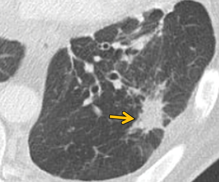 Bronchocentric granulomatosis in three patients. (a) Axial CT image in a 35-year-old man shows a spiculated nodule (arrow) in the left lower lobe. (b) Axial CT image in a 44-year-old woman shows peribronchovascular consolidation (white box) with tiny satellite nodules (arrow). (c) Axial CT image in a 51-year-old woman shows right lower lobe consolidation (dashed box) with peripheral bronchiectasis (purple arrow) and cystic bronchiectasis (blue arrow) with mucus plugging in the left lower lobe.